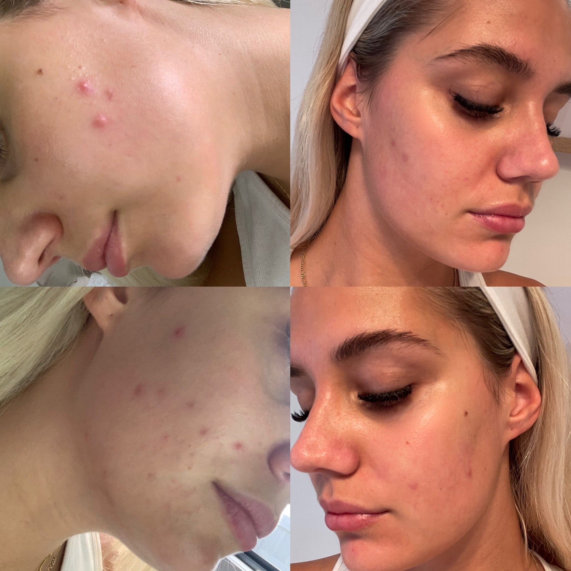 skin care for sensitive skin, blemish gel, clean skin care, face care products, natural pimple gel, quick acting blemish gel, tea tree gel for pimples, before and afters