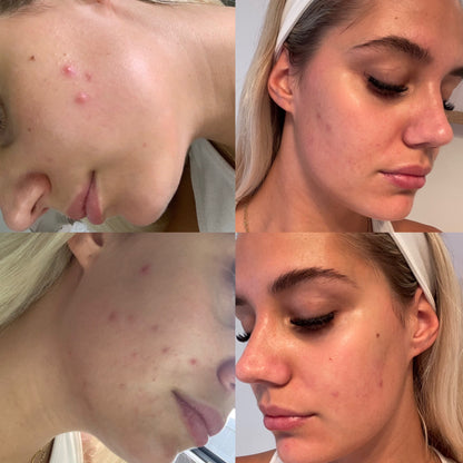 skin care for sensitive skin, blemish gel, clean skin care, face care products, natural pimple gel, quick acting blemish gel, tea tree gel for pimples, before and afters