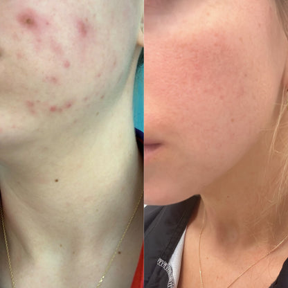 skin care for sensitive skin, blemish gel, clean skin care, face care products, natural pimple gel, quick acting blemish gel, tea tree gel for pimples, before and afters